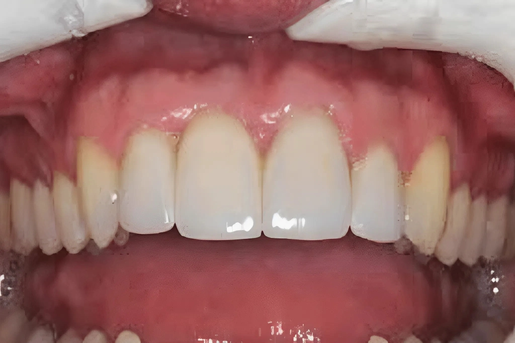 Lựa chọn màu sắc không phù hợp làm răng sứ lệch màu (Nguồn: Sưu tầm)